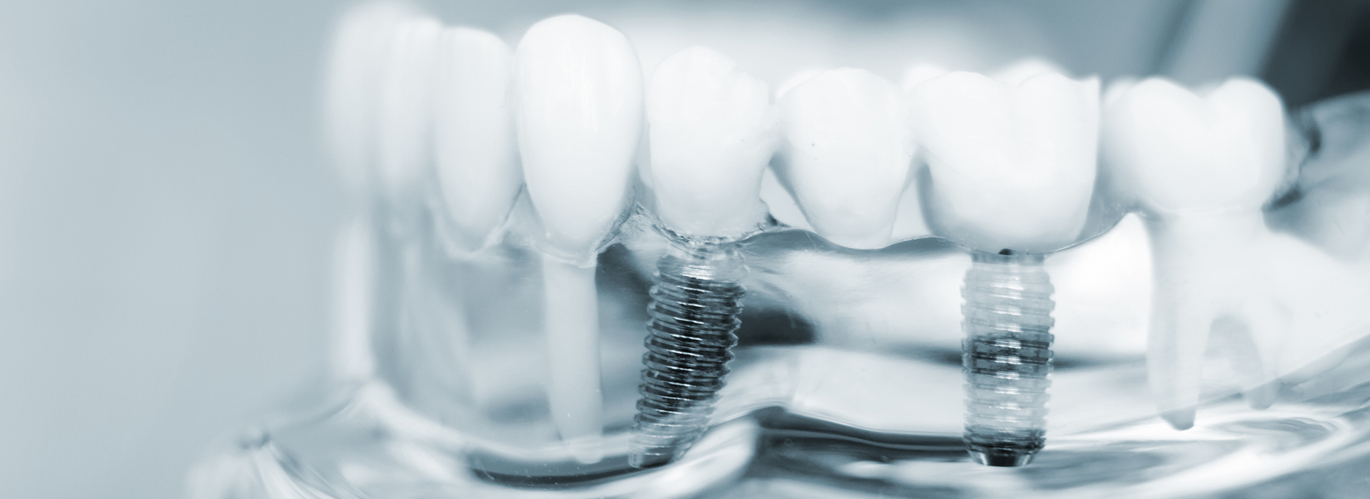 The image shows a close-up of multiple teeth with visible fillings and braces, set against a blurred background that appears to be the inside of a mouth or dental equipment.