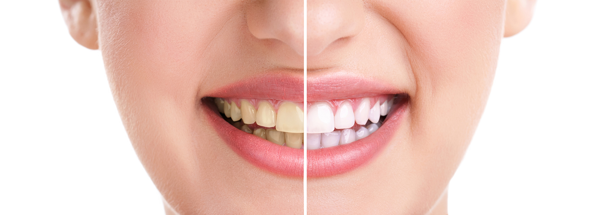 A close-up of a smiling woman with teeth, showcasing dental care or a smile enhancement product.